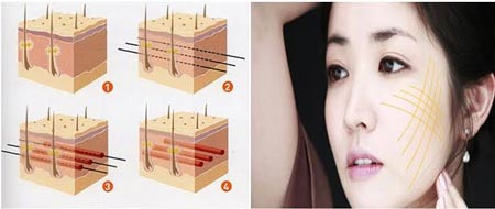 Ứng dụng căng da mặt bằng chỉ theo công nghệ Hàn Quốc