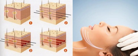 Căng da mặt bằng chỉ tại Thẩm mỹ Hồng Ngọc