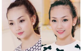 Theo chân khách hàng độn cằm V-line tại thẩm mỹ viện Xuân Hương