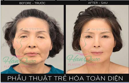 Trẻ hóa toàn diện tại Thẩm mỹ Hàn quốc JW