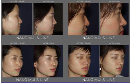 Những hình ảnh Nâng mũi s line tại Thẩm mỹ Hàn Quốc JW năm 2013