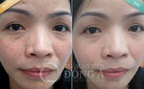 Ngày hội tư vấn trị nám – tàn nhang từ chuyên gia