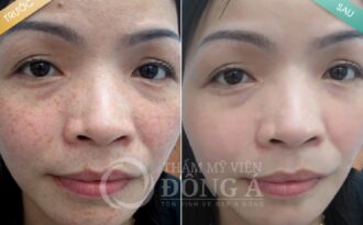 Ngày hội tư vấn trị nám – tàn nhang từ chuyên gia