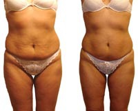 Giảm béo sau sinh