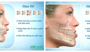 Phẫu thuật chỉnh hàm hô móm (vẩu) không cần niềng răng