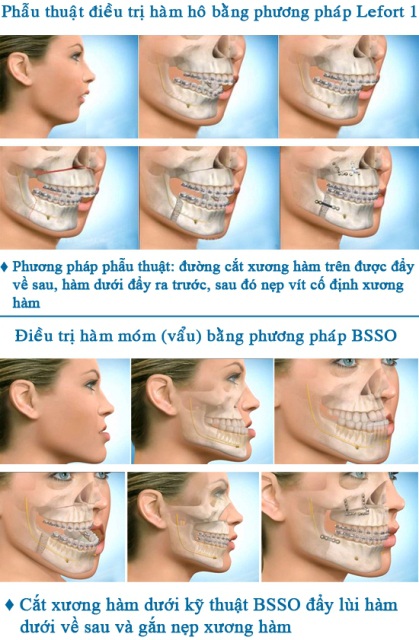 Phương pháp phẫu thuật hàm hô – móm (vẩu) tại Thẩm Mỹ Hàn Quốc – 2A Phan Kế Bính