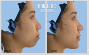 Phẫu thuật chỉnh nha hàm hô