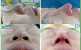 Nâng mũi Hàn Quốc công nghệ Tutoplast & Megaderm