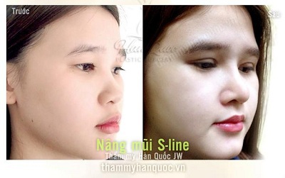 Một ca nâng mũi S Line tại Thẩm mỹ Hàn Quốc JW VN.