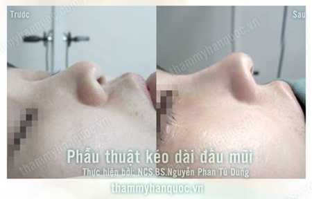 Sửa mũi ngắn hếch bẩm sinh