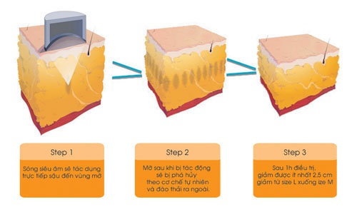 Các bước hoạt động của Liposonix.