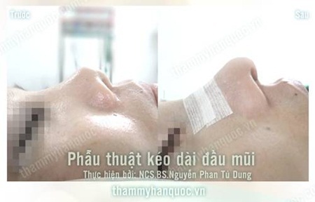 Sửa mũi ngắn hếch bẩm sinh