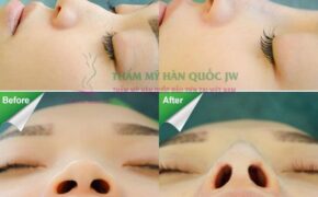 Nâng mũi s line có nhất thiết phải gây mê hay không?