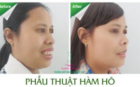 700 ca phẫu thuật hô móm không cần niềng răng và lời khuyên từ chuyên gia