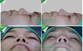 Nâng mũi Sline bằng Demoderm