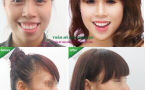 Những lưu ý đặc biệt về phẫu thuật hàm hô, móm