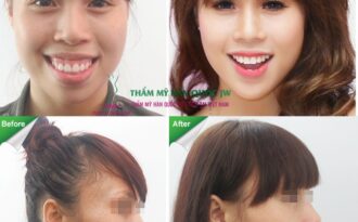 Những lưu ý đặc biệt về phẫu thuật hàm hô, móm