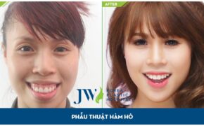 Phẫu thuật hàm hô, móm – cuộc đời nở hoa hay cuộc sống bế tắc?