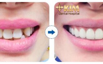 Bọc răng sứ không cần mài răng tại Bệnh viện Răng Hàm Mặt Sài Gòn