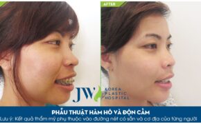 Nên lựa chọn niềng răng (chỉnh nha) hay phẫu thuật hàm