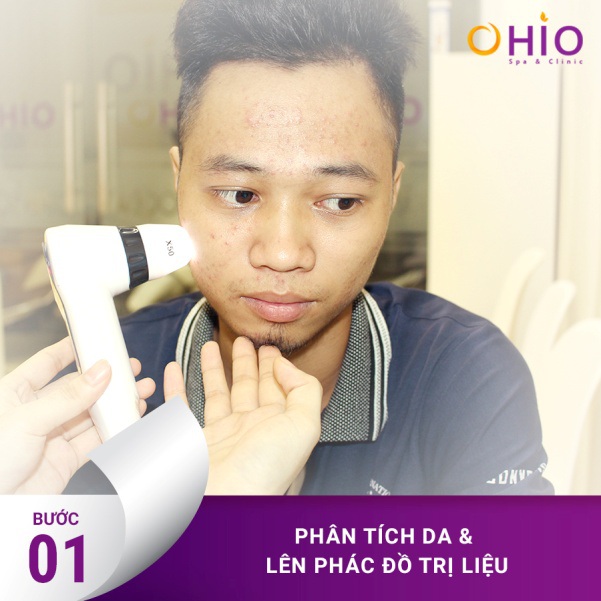 Công nghệ laser acnes giải pháp trị mụn hoàn toàn mới - 2