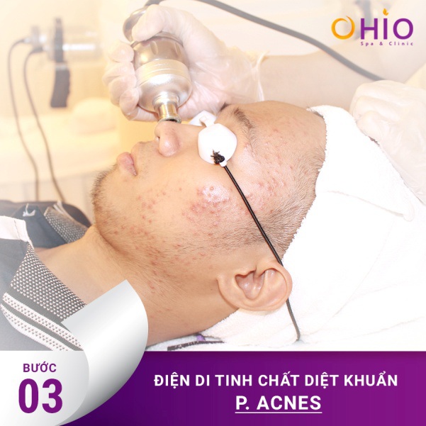 Quy trình điều trị mụn công nghệ Laser acnes tại Ohio Spa & Clinic