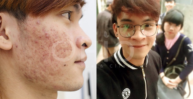 Hình ảnh khách hàng sau điều trị mụn công nghệ Laser Acnes