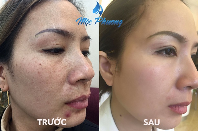 Kết quả đạt được sau khi điều trị nám ở Mộc Phương Beauty Salon luôn khiến khách hài lòng