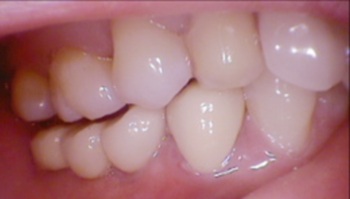 Quy trình cấy ghép implant - 3