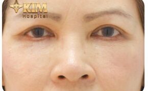 Thẩm mỹ mắt Midface: bí quyết lưu giữ thanh xuân cho tuổi trung niên