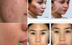 Trị mụn hiệu quả bằng công nghệ Healite