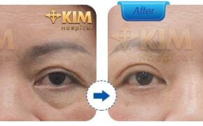 Lấy bọng mỡ mắt: Bí quyết lấy lại tuổi thanh xuân của chị em U40