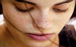 Trị nám da hiệu quả bằng công nghệ mới Spectra Laser