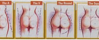 Điều cần biết khi phẫu thuật nâng “vòng 3”