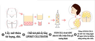 Nâng ngực, nâng mông an toàn bằng Stem Cell từ mỡ của chính mình.