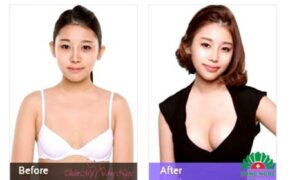 Nâng ngực nội soi đẹp Hàn Quốc