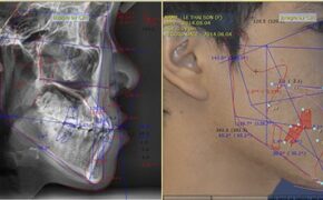 Cơ hội niềng răng miễn phí 100%