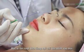 Chọn chỉ sinh học nâng mũi an toàn, không biến chứng theo tư vấn của bác sĩ
