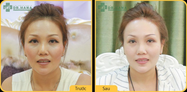 Hình ảnh trước và sau khi căng da mặt của Việt Kiều Mỹ Hoàn Thy