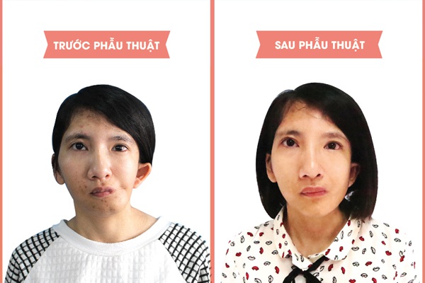 Hình ảnh em Đoàn Thu Thương trước và sau phẫu thuật.