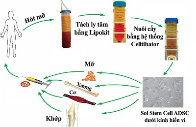 Quy trình tạo Stem Cell từ Mỡ bằng hệ thống Lipokit tại bệnh viện thẩm mỹ Á Âu.