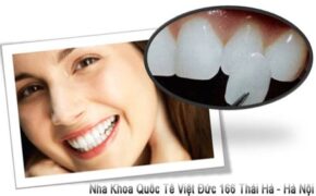 Tái tạo nụ cười với răng sứ Veneer