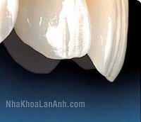 Có những loại răng sứ nào?