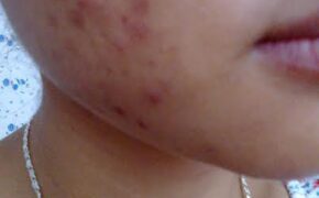 Chia tay mụn, sẹo mụn, sẹo thâm: Khó mà dễ