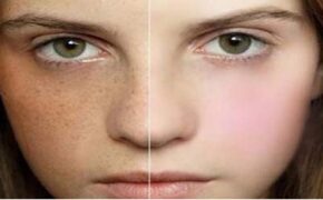 Trị tàn nhang hiệu quả bằng công nghệ Solari IPL