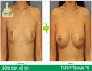 Nâng ngực nội soi công nghệ mới từ Thẩm mỹ Hàn Quốc