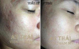 Trị sẹo lõm bằng công nghệ 5D