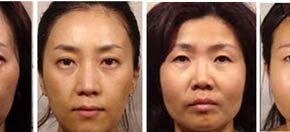 Trẻ đẹp da với tế bào gốc tự thân