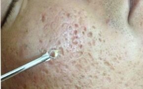 600 khách hàng được trị mụn trứng cá miễn phí